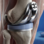 Meduloc Raises $4M